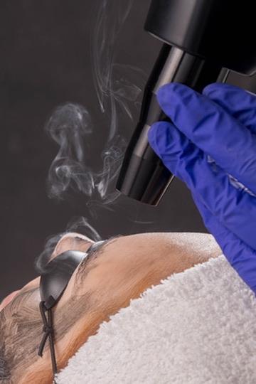 Protocolo Carbon Peeling com Laser NdYag